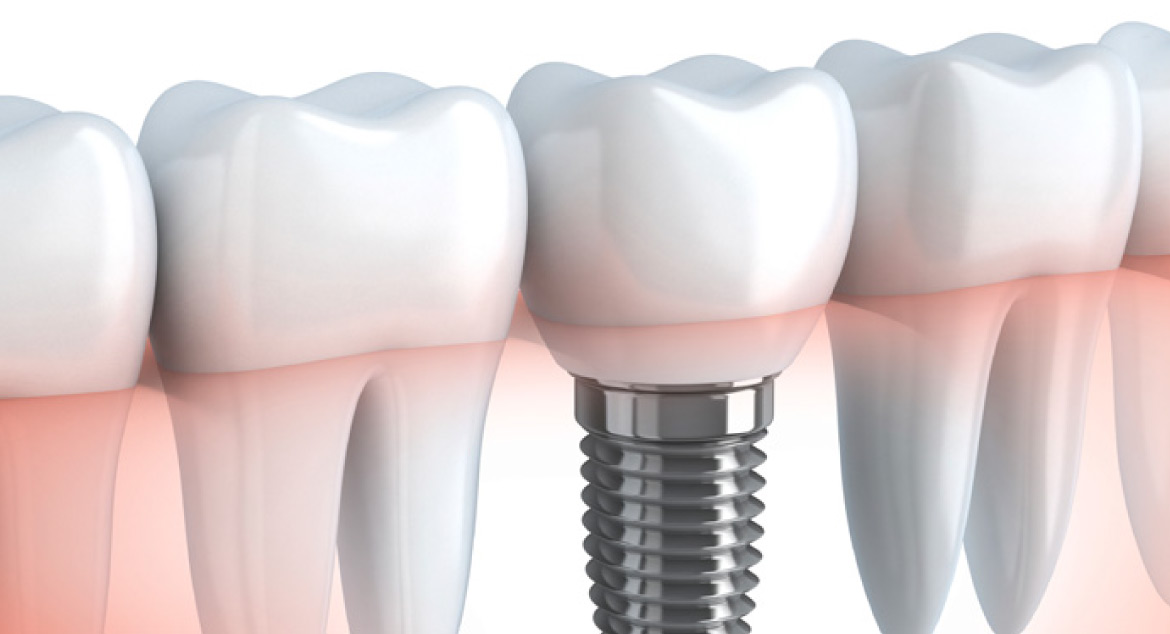 Implantes Dentales: Datos Clave