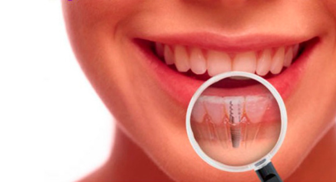 Implantes dentales = calidad de vida