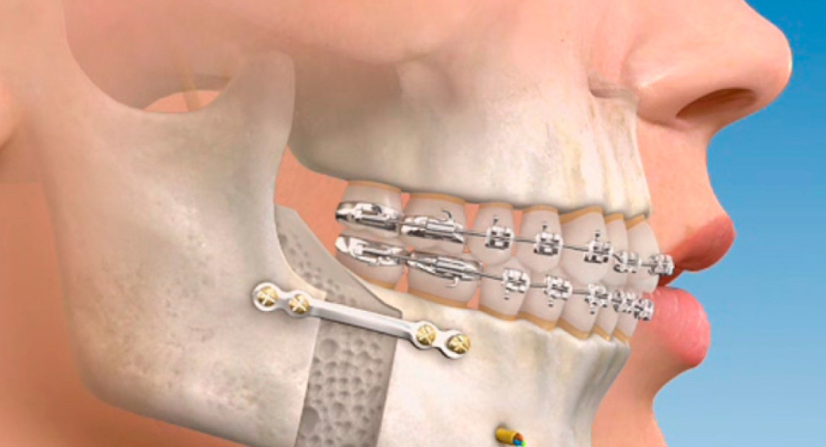 Problemas más comunes en cirugía maxilofacial